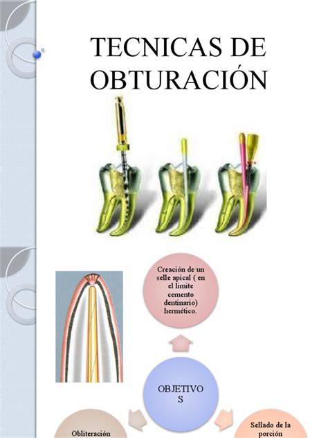 infographics de conductos en C y técnicas de obturación
