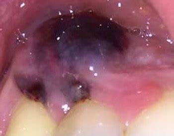 imagen de hemangioma cavernoso oral