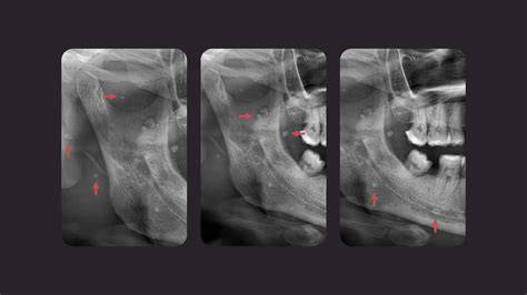 radiografía de hemangioma con flebolitos