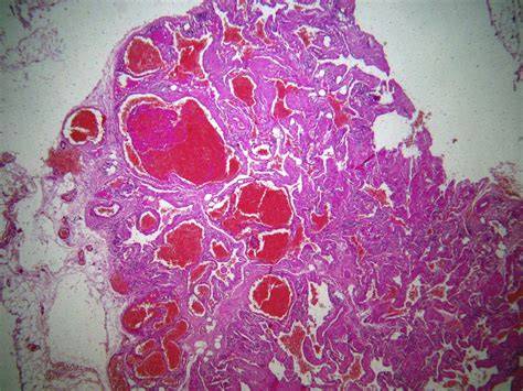 cirugía de hemangioma mediastínico